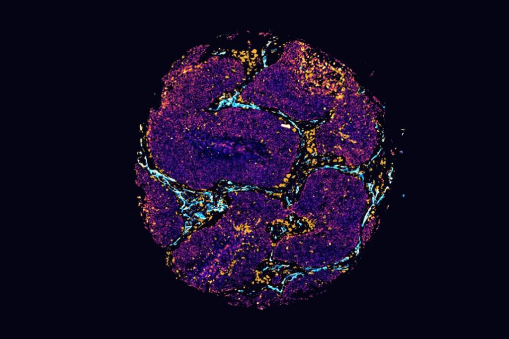 Non-small cell lung cancer tissue mapped cell-by-cell through multiplex spatial imaging.